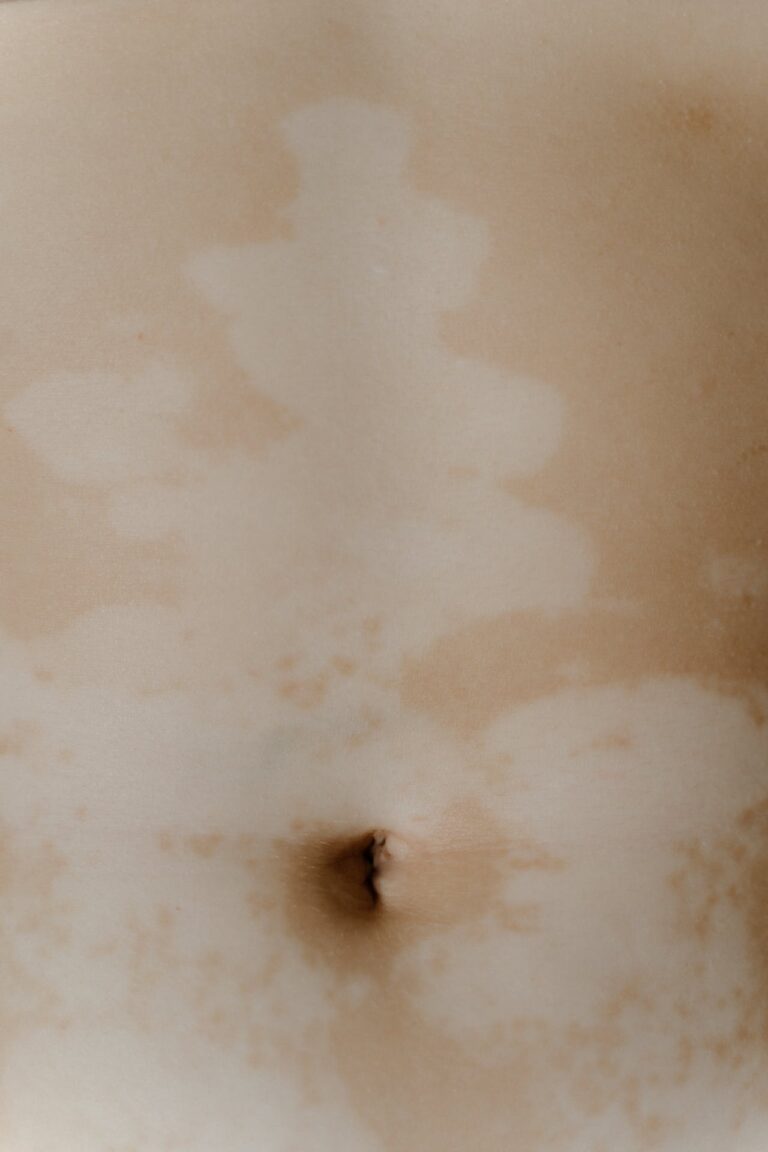 A vitiligo betegség áttekintése